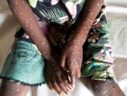 Cina akan Melakukan Pemantauan Kepada Orang atau Barang dari Afrika dan Timur Tengah Ke Negara Tersebut. Mencegah Penyebaran Virus Mpox