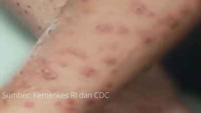 Wabah virus Mpox tidak akan menjadi pandemi seperti Covid-19