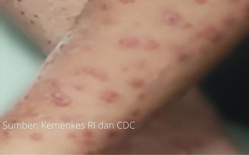 Wabah virus Mpox tidak akan menjadi pandemi seperti Covid-19