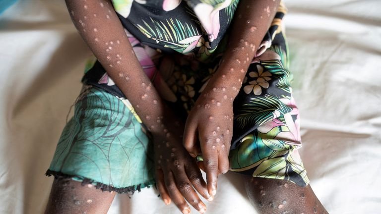 Virus Mpox mulai didapati diberbagai negara di dunia